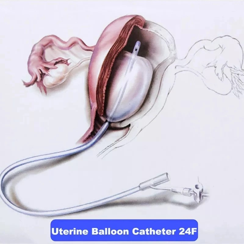 Medical Consumables Postpartum Hemostatic Dilation Balloon